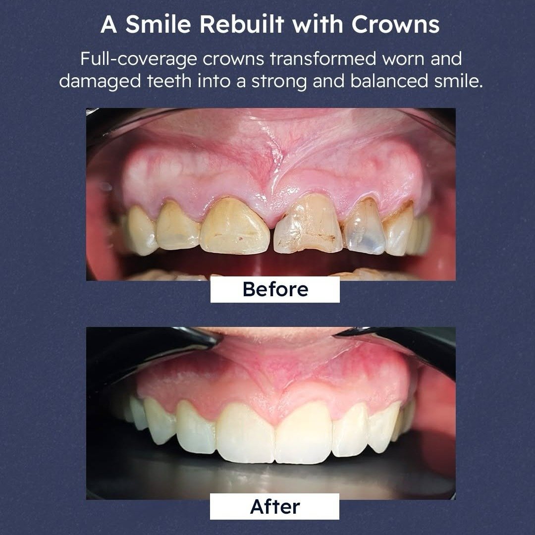 Before and after: a smile rebuilt with full coverage crowns