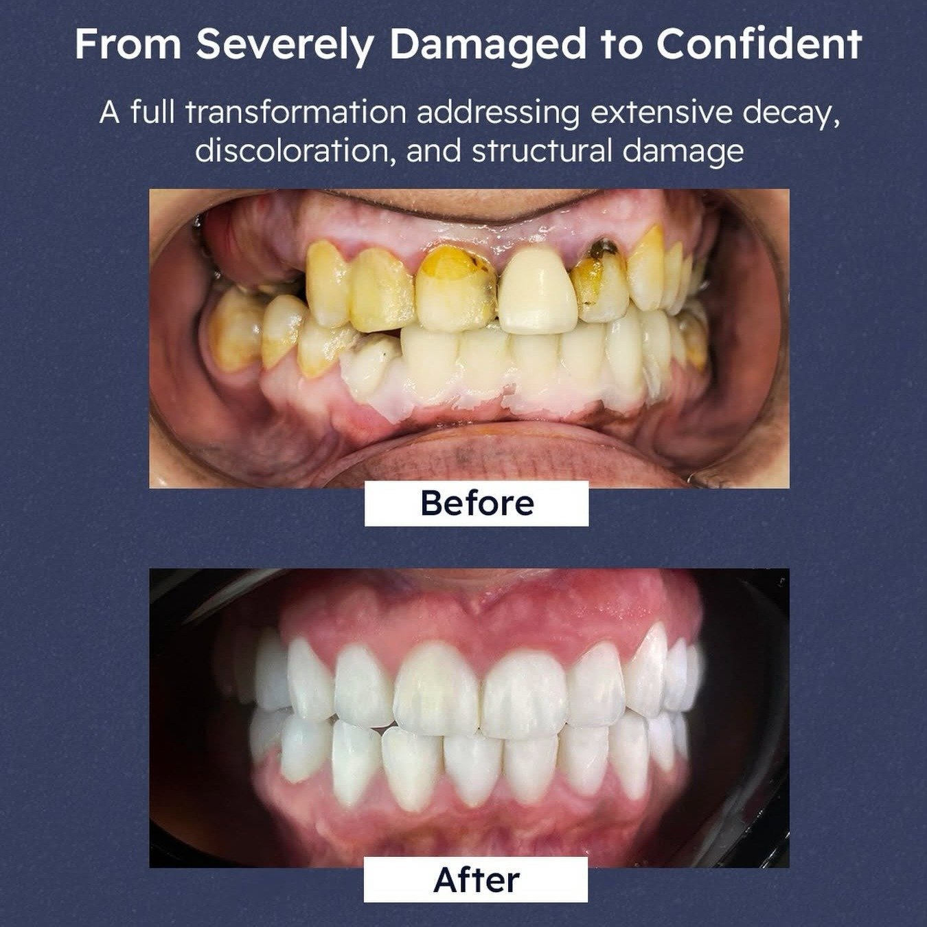 Before and after: from severely damaged teeth to a confident smile
