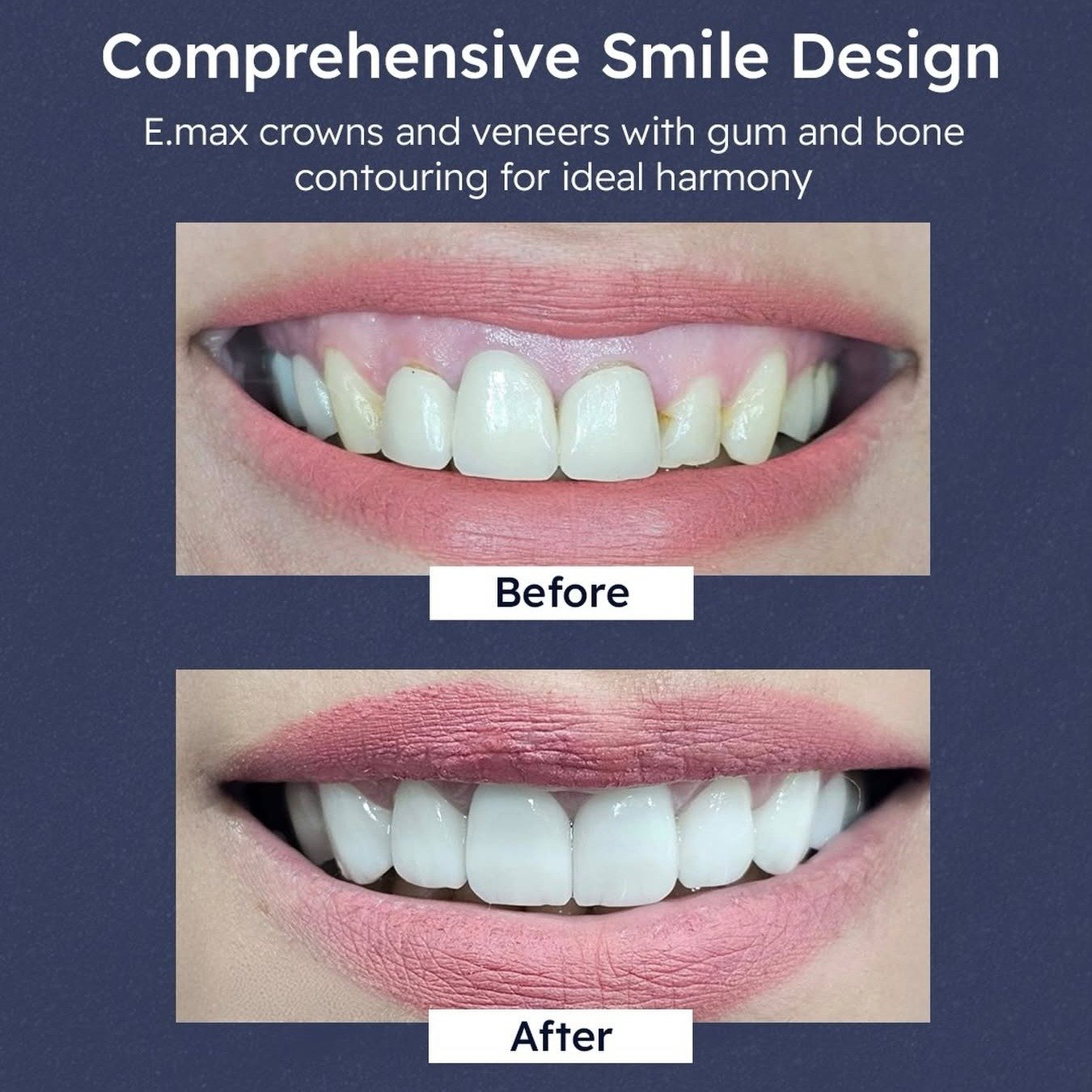 Before and after: comprehensive smile design using E.max crowns and veneers