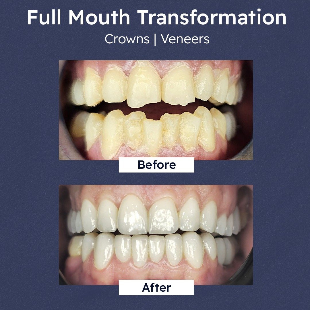 Before and after: full mouth transformation using crowns and veneers on worn teeth