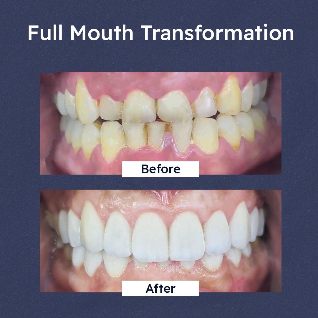 Before and after: full mouth transformation restoring worn, uneven and discoloured teeth