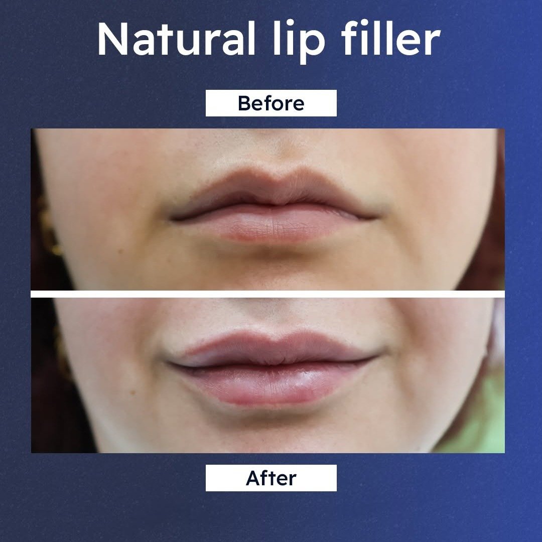 Before and after: natural lip filler result