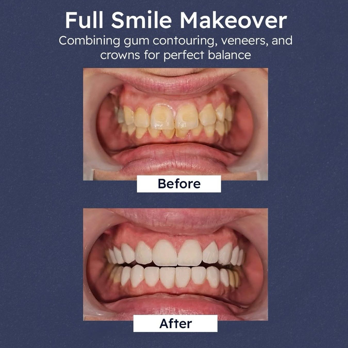 Before and after: full smile makeover combining gum contouring, veneers and crowns