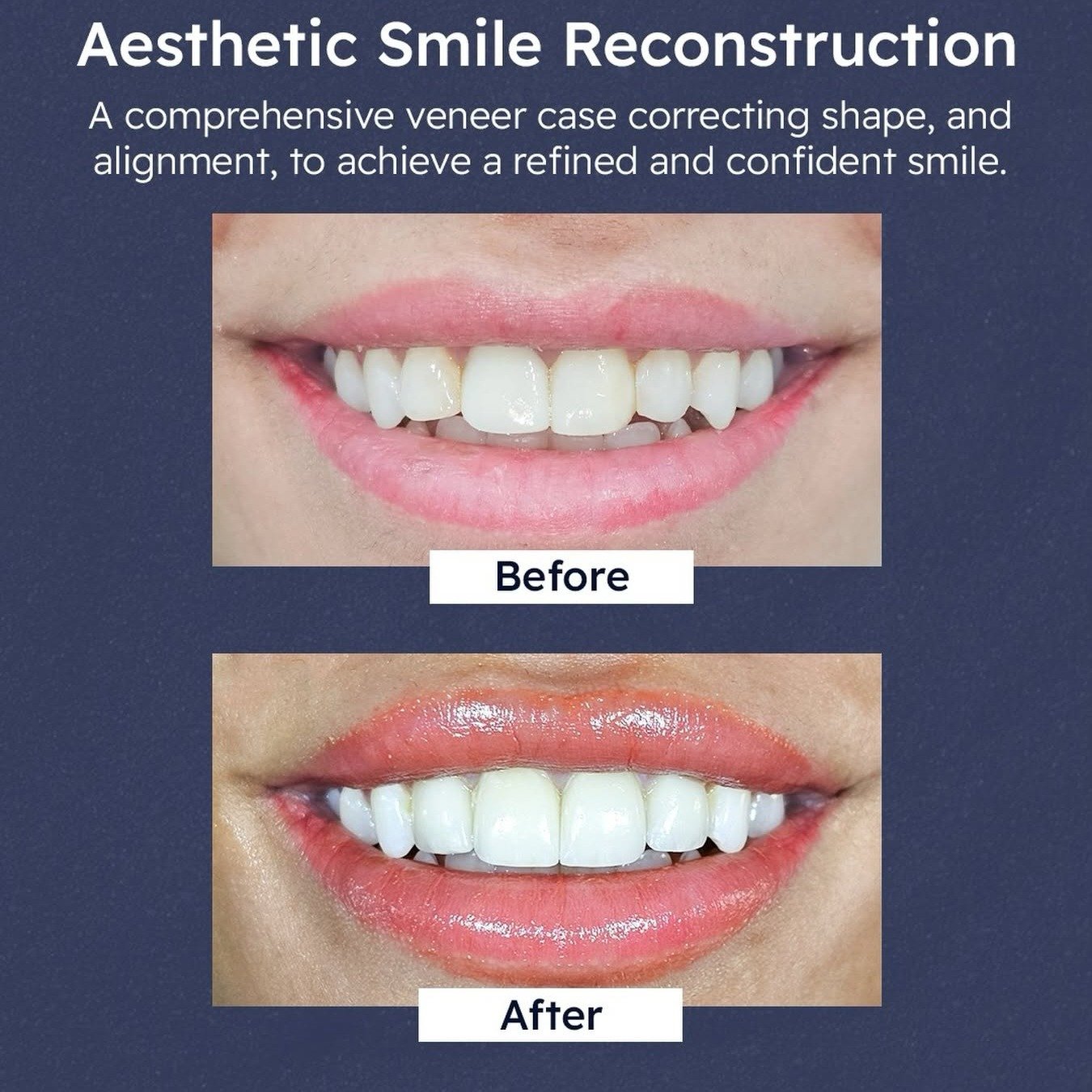 Before and after: aesthetic smile reconstruction with veneers, correcting shape and alignment